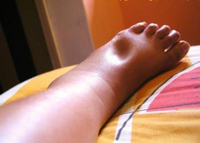 Лимфостаз ног народные средства лечения thumbnail