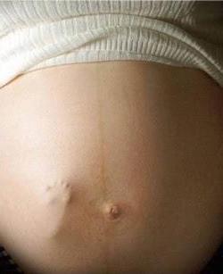 Признаки беременности на 3 день после зачатия. Перемены в молочных железах. Пигментная полоска на животе