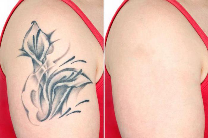 Удаление татуировок до и после