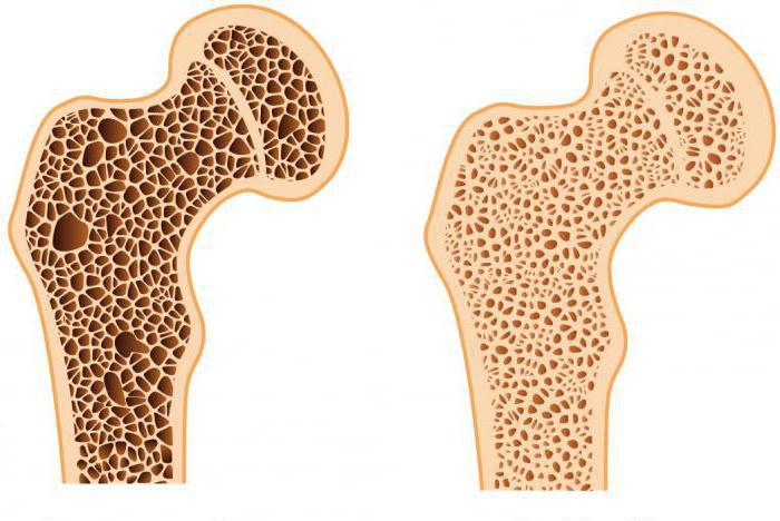 заболевание остеопороз