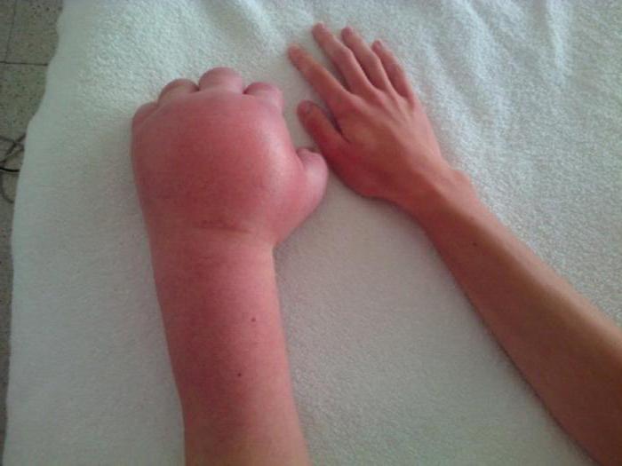 Синдром Зудека после перелома кости руки