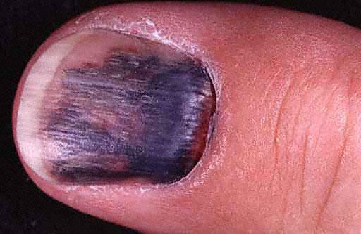Гематома на руке после ушиба лечение народными средствами thumbnail