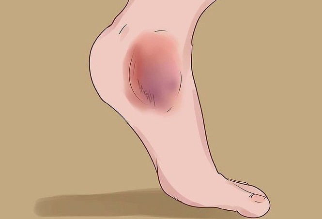 Народные средства для лечения гематомы на ноге thumbnail