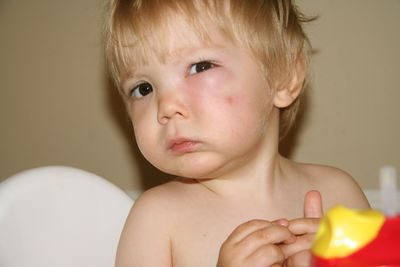 Лечение укуса мошки на глазу у ребенка thumbnail