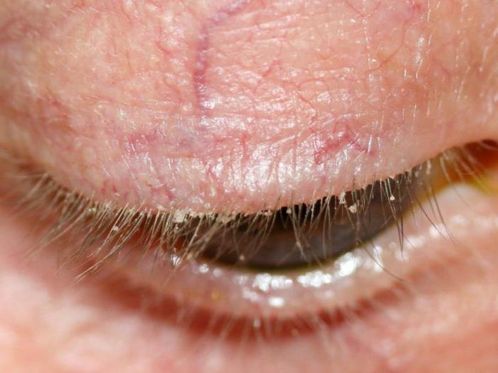 Лечение демодекоза глаз у человека народными средствами в домашних условиях thumbnail