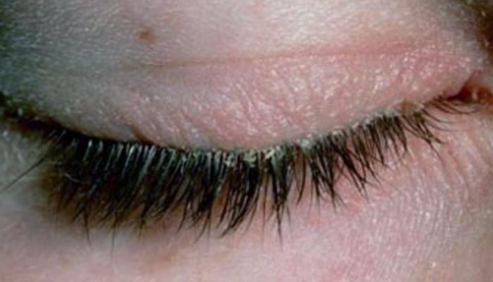 Глазной клещ у человека лечение народными средствами thumbnail