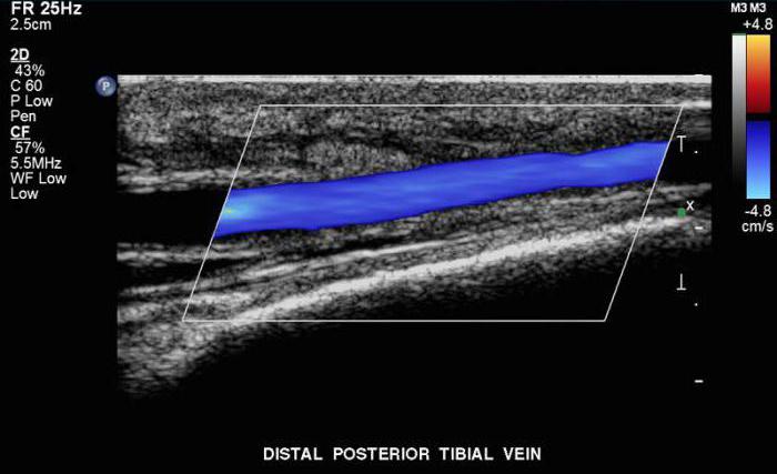 узи кровеносных сосудов нижних конечностей
