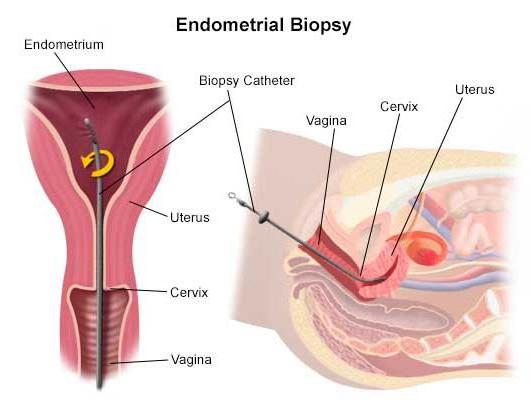 пайпель биопсия эндометрия последствия отзывы