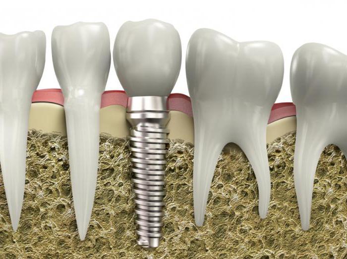 имплантация зубов противопоказания и возможные осложнения