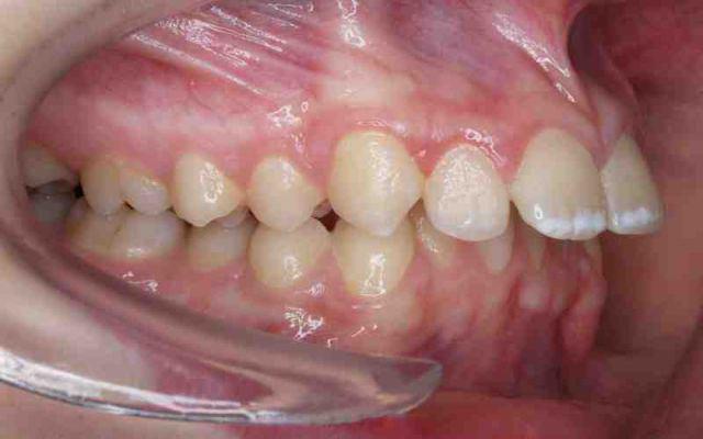 какие противопоказания при имплантации зубов