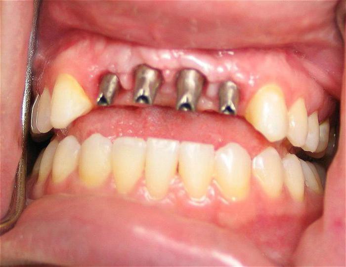 осложнения после имплантации зубов
