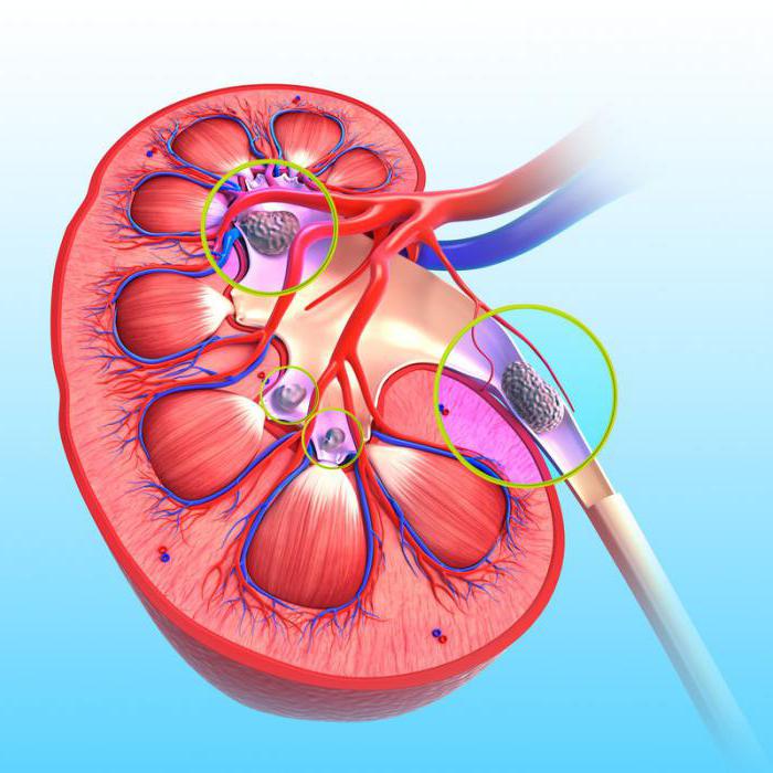 нефролитиаз что это такое