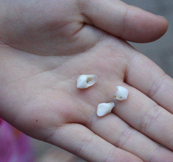 выпадение молочных зубов у детей возраст 