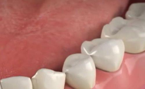 протезирование при полном отсутствии зубов 