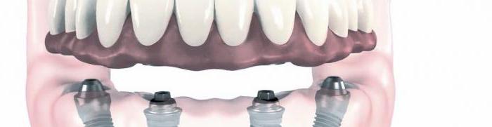 протезирование зубов виды 