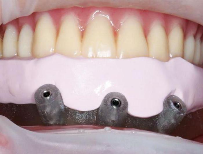 протезирование зубов какие протезы лучше 