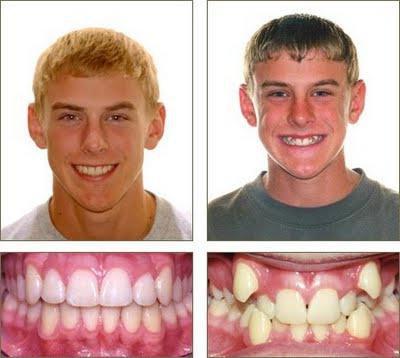 брекеты фото до и после лечения 