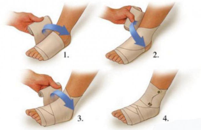 подвернула ногу и опухла щиколотка что делать