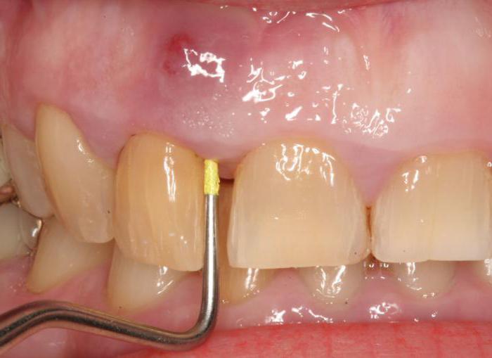 абсцесс зуба лечение