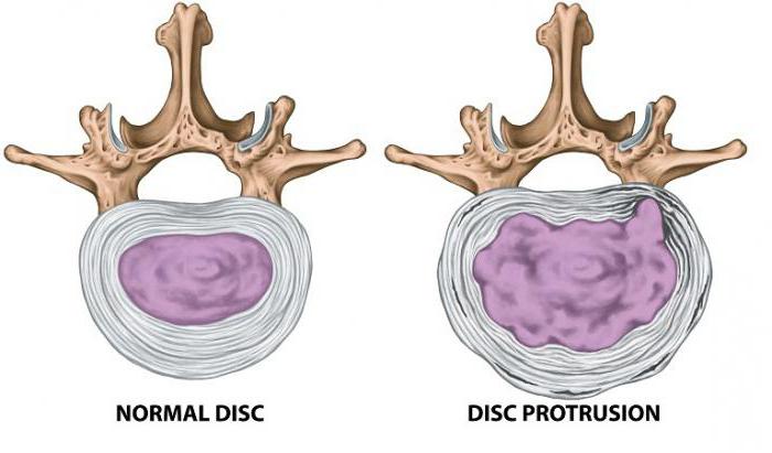 остеохондроз шейного отдела позвоночника с протрузиями дисков