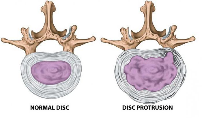 Как вылечить протрузию в шейном отделе thumbnail