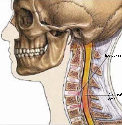 протрузии межпозвонковых дисков шейного отдела позвоночника 