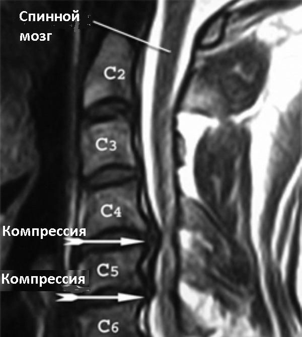 протрузии дисков шейного отдела позвоночника 