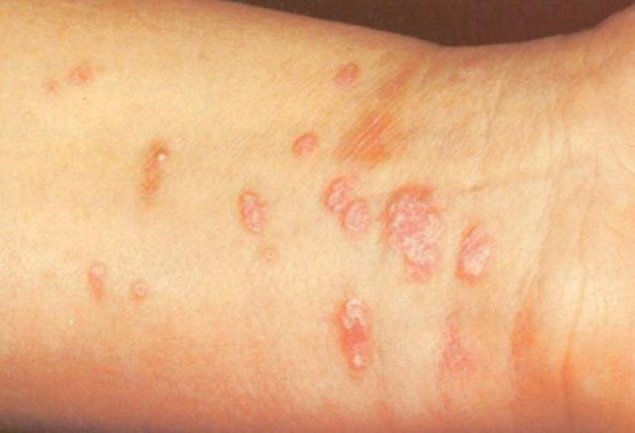 аллергия на коже красные пятна