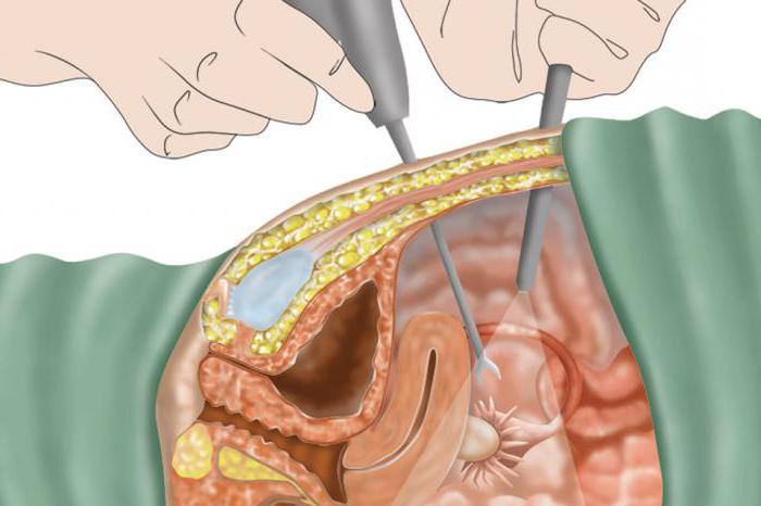 лапароскопия спаек маточных труб 