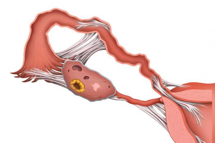 спайки в маточных трубах причины возникновения