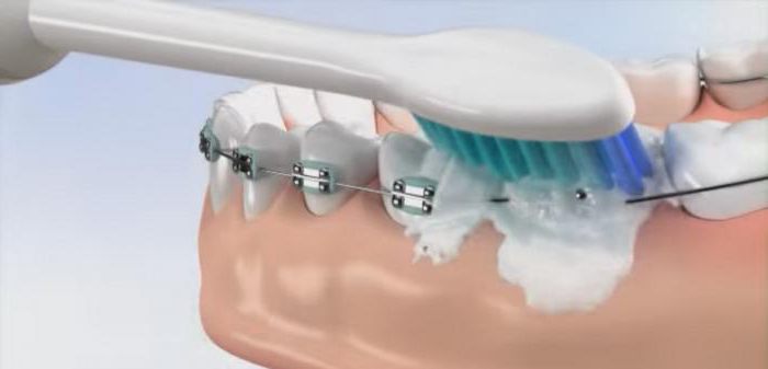 ортодонтическая зубная щетка для брекетов