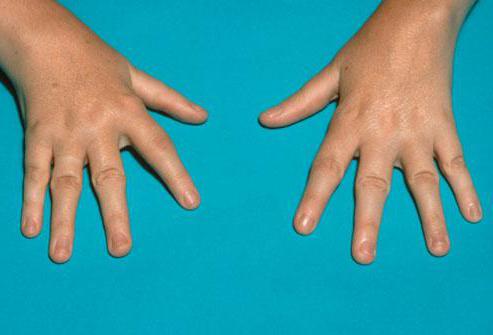 Какой врач лечит ревматоидный артрит пальцев рук thumbnail