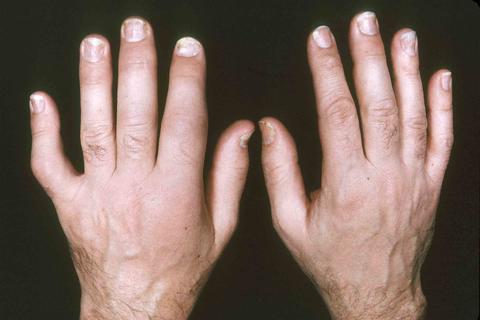 ревматоидный артрит пальцев рук первые симптомы фото