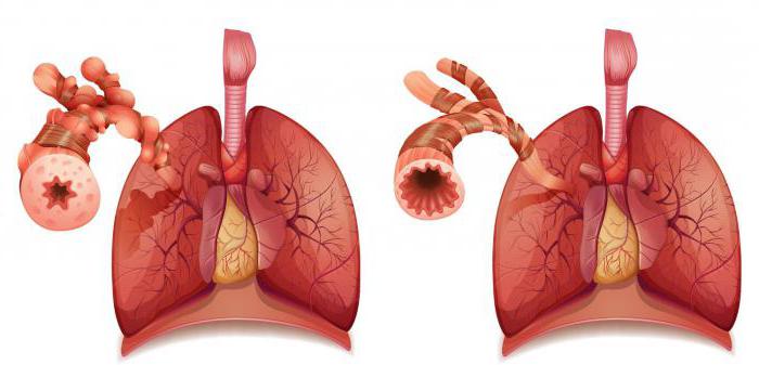 Натрия хлорид при бронхиальной астме thumbnail