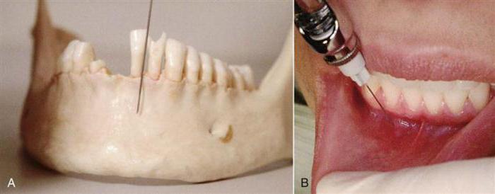 торусальная анестезия в стоматологии 