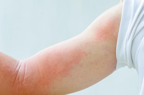 виды аллергии на коже