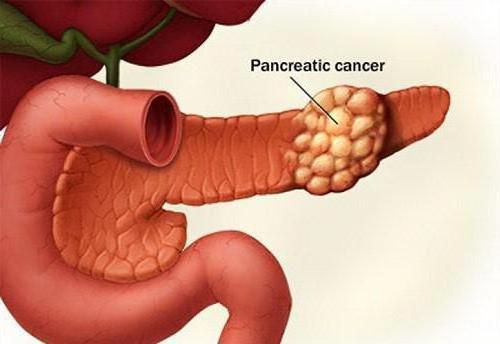 диагностика панкреатита у взрослых 