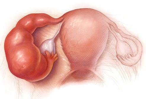 болит яичник во время беременности