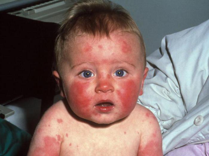 парвовирусная инфекция у детей фото сыпи у детей