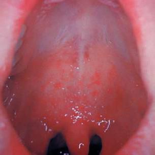  парвовирусная инфекция у детей симптомы фото начальная стадия фото 