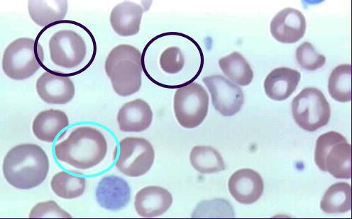 анизоцитоз в общем анализе крови 