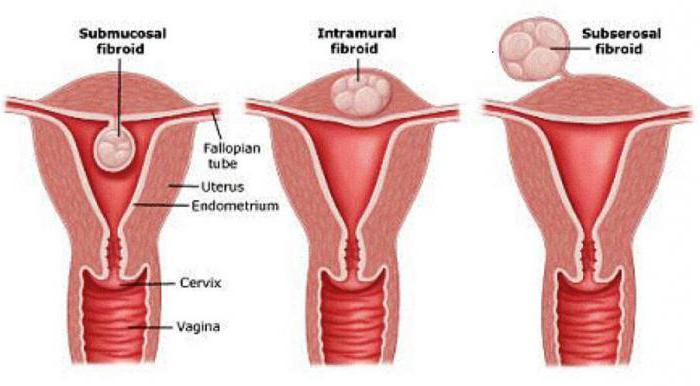 Как забеременеть если в матке маленькая миома thumbnail