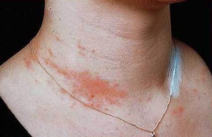 аллергия на металл на коже лечение 