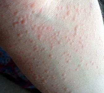 аллергия на порошок у ребенка 
