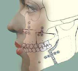 альвеолярный отросток верхней челюсти