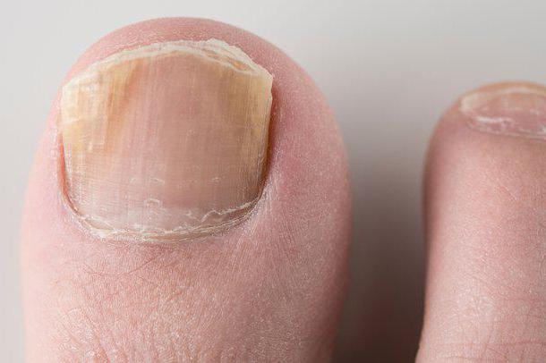 Грибок ногтей на ногах лечение в домашних условиях микозан thumbnail