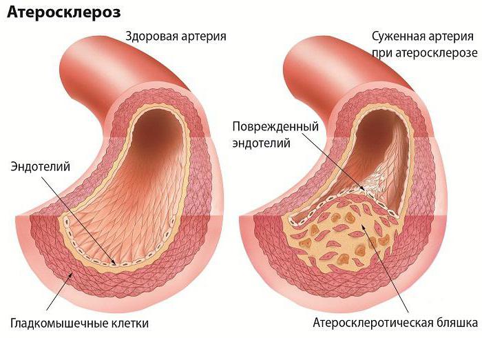 кальцинированная бляшка в сонной артерии лечение