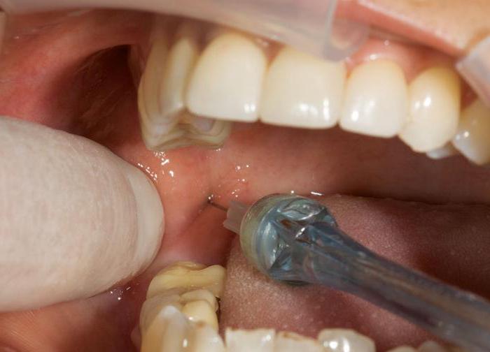 общая анестезия в стоматологии 
