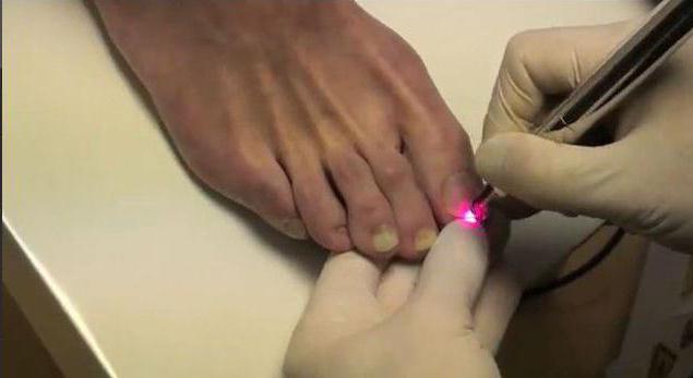 анализы на грибок ногтей на ногах