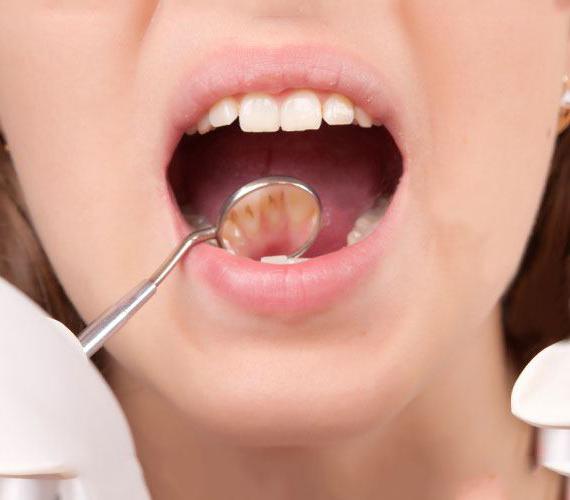 лечение кариеса зубов 